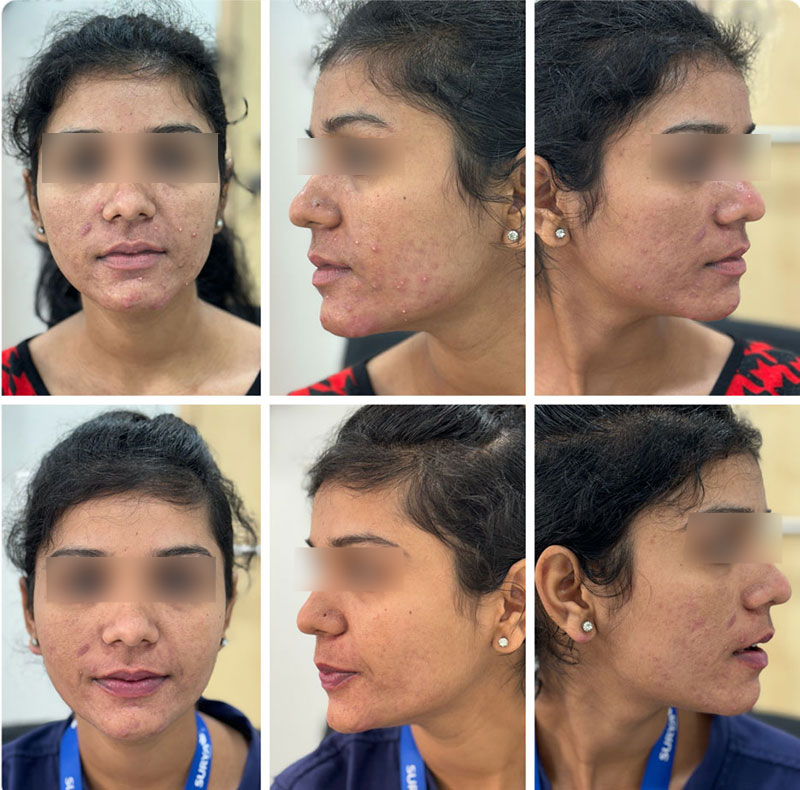 Nose Treatment Before After